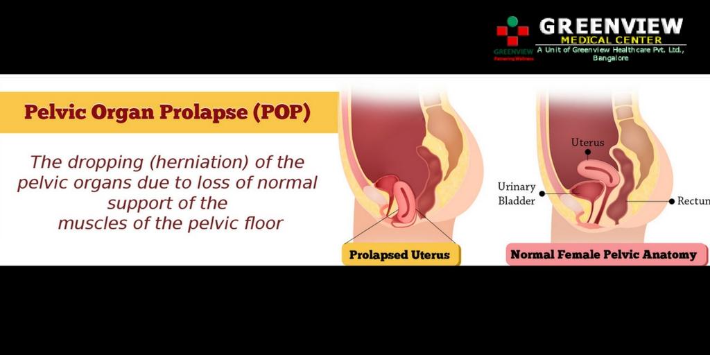 Prolapse of the Pelvic Organs - Greenview Medical Center