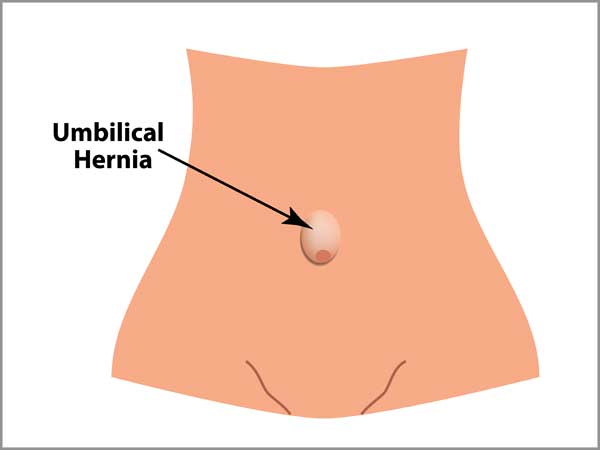 Umbilical Hernia Repair - Greenview Medical Center