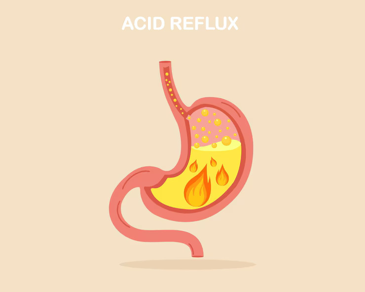 Acid-Reflex