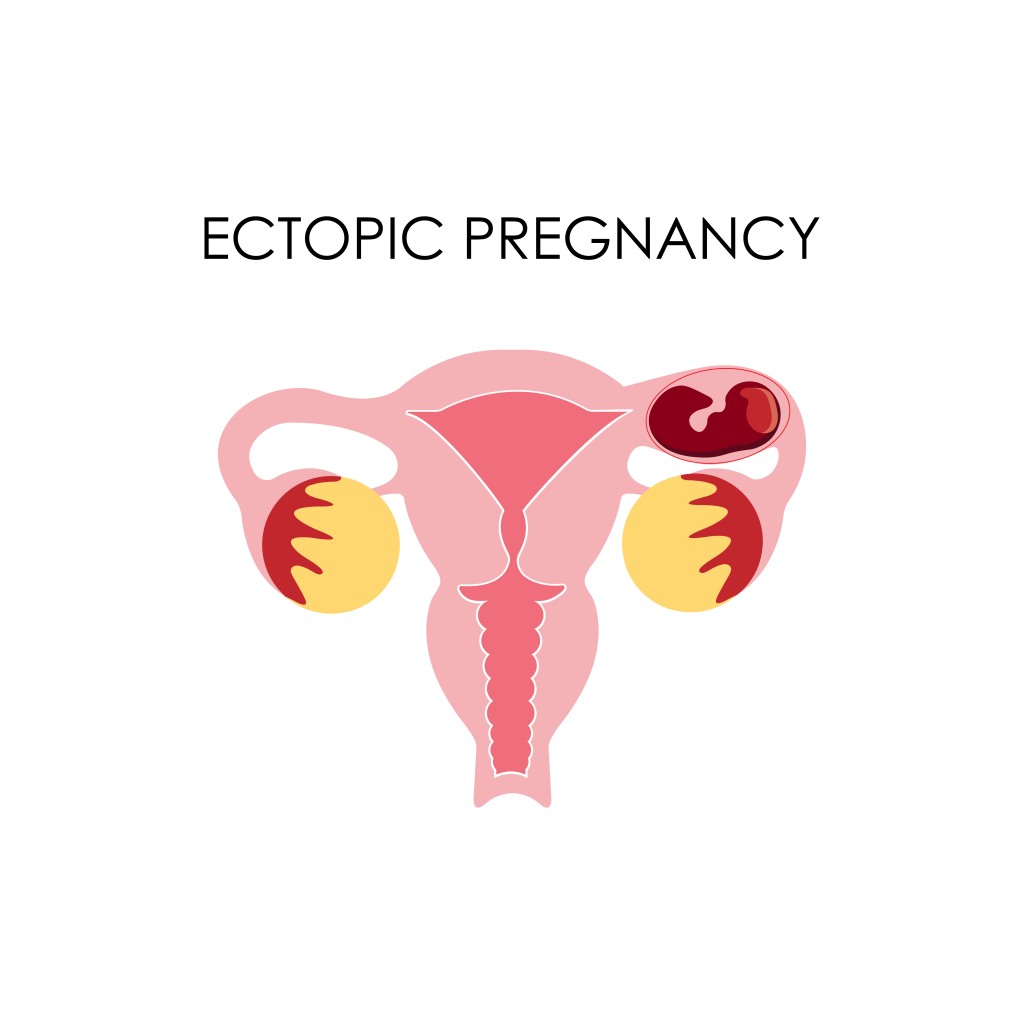 Ectopic Pregnancy (2)