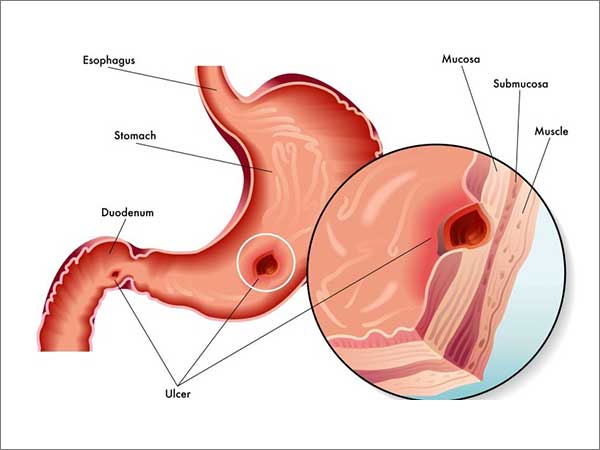 Peptic-Ulcer-Disease