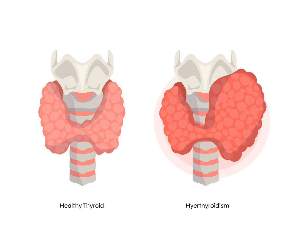 Thyroid