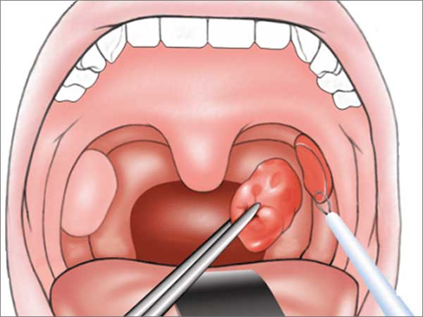 Tonsillectomy-Adenoidectomy