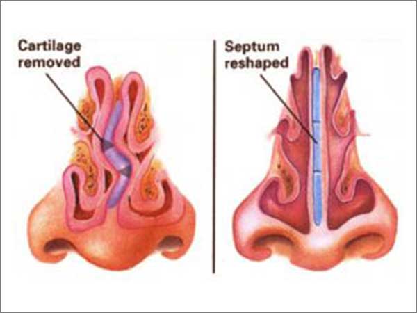 Turbinectomy-Septoplasty