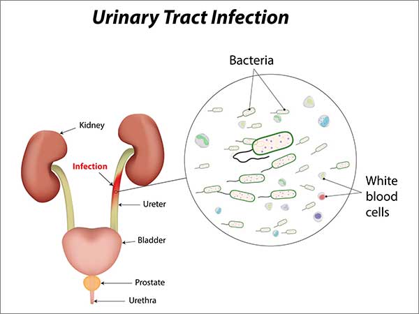 Urinary-Tract-Infection