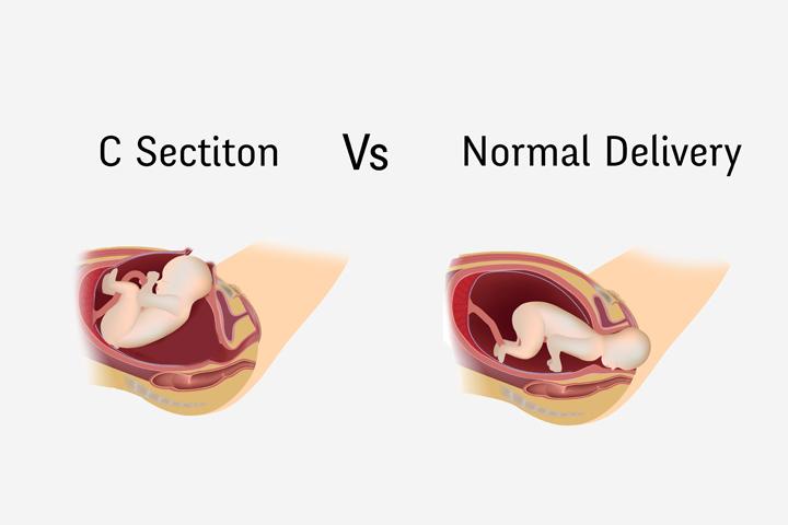 cesarean-delivery