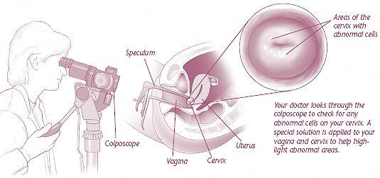 colposcopy