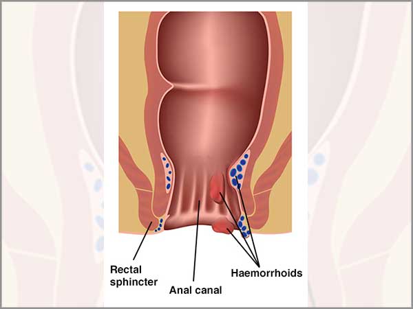 haemorrhoidectomy