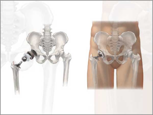 hemiarthroplasty-bipolar