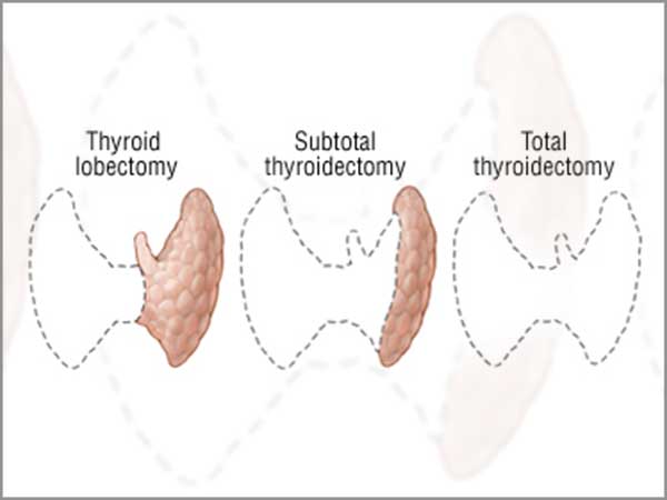 thyroidectomy