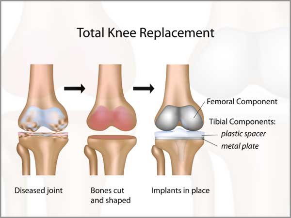 total-knee-replacement