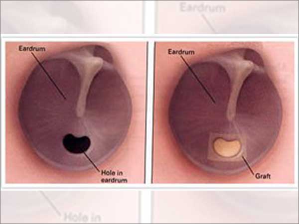 tympanoplasty