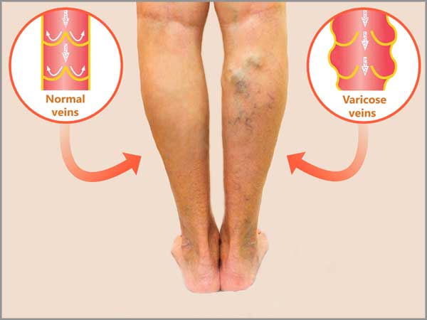 varicose-veins-stripping